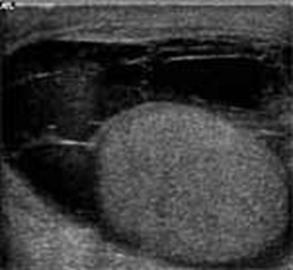 Departamentul de Urologie Pediatrica, Andrologie si Chirurgie Routina dgkb Nr. 13 ova - edemul cojilor de testicule