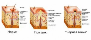 Відгуки про очищувальну вугільної масці - black mask - від чорних крапок і вугрів на обличчі