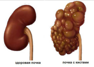 Chistul parenchimat al rinichiului stang ceea ce este și tratamentul