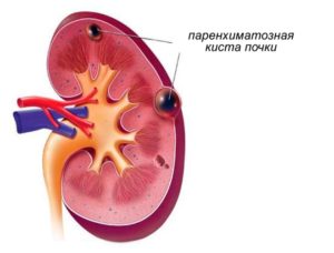 Chistul parenchimat al rinichiului stang ceea ce este și tratamentul