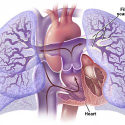 Hipertensiunea pulmonară primară - bisturiu - informație medicală și portal educațional