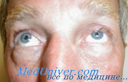 Первинний ідіопатичний міозит очі (орбіти)