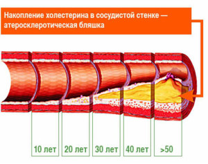 Nutriție pentru arteroscleroza meniurilor vaselor, produse