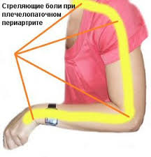 Плечолопатковий періартрит - запалення тканин в плечовій області