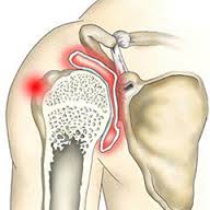 Umflarea periartrită a vezicii urinare - inflamarea țesuturilor în regiunea umărului