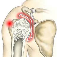 Плечолопатковий періартрит - запалення тканин в плечовій області