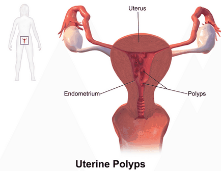Polyp de endometru 1
