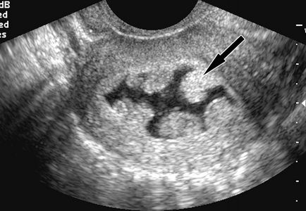 Polyp de endometru 1