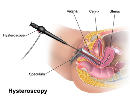 Polyp de endometru 1