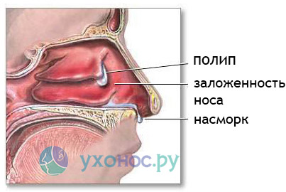 Polipi în simptomele nasului, tratament, îndepărtare