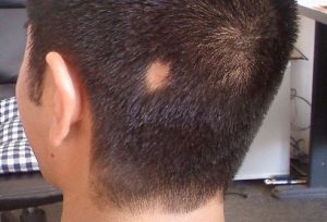 Cauza completa alopecie, diagnostic, tratament