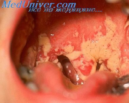 Cavitatea orală cu infecție HIV (SIDA)
