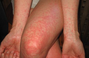 Допомога при алергічний дерматит у дорослих причини, симптоми, ніж лікувати