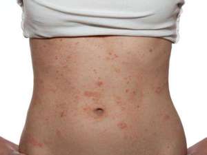 Допомога при алергічний дерматит у дорослих причини, симптоми, ніж лікувати