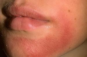Segítség az allergiás dermatitis felnőttek okok, tünetek, mint kezelni