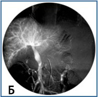 Portal hipertensiune arterială la un copil