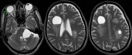 Cauzele de accident vascular cerebral al creierului Stresul, vârsta, hipertensiunea arterială