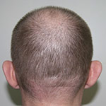 Cauzele alopeciei, clinicii medicale