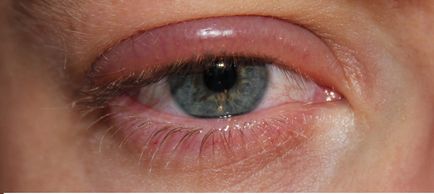 Simptomele de orz pe ochi