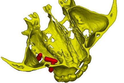 Programul de implantare dentară pe un șablon chirurgical