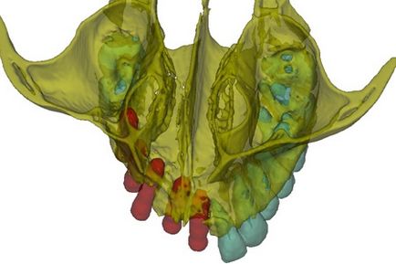 Programul de implantare dentară pe un șablon chirurgical