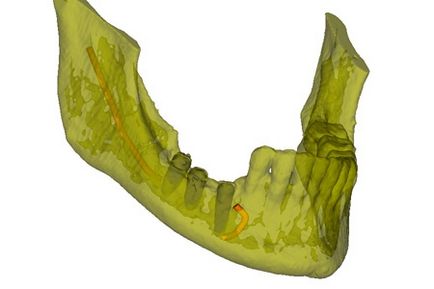 Programul de implantare dentară pe un șablon chirurgical