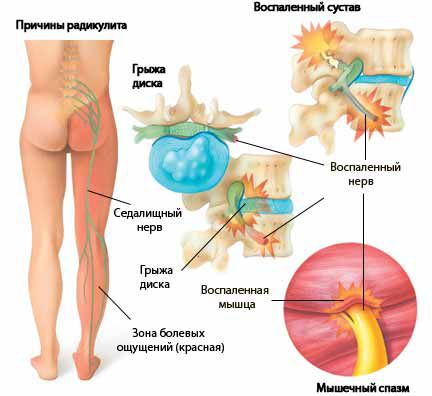 Радикуліт причини, симптоми, лікування захворювання