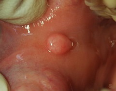 Cancerul oral