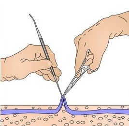 Recomandări după prevenirea complicațiilor prin flebectomie