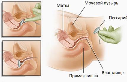 Симптоми і лікування опущення матки