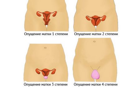 Симптоми і лікування опущення матки