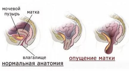 Симптоми і лікування опущення матки