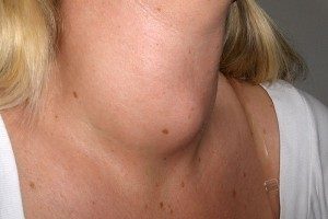 Simptomele, cauzele și tratamentul bolilor glandei tiroide