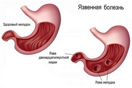 Szirup édesgyökér köhögés hasznos tulajdonságai és alkalmazásai