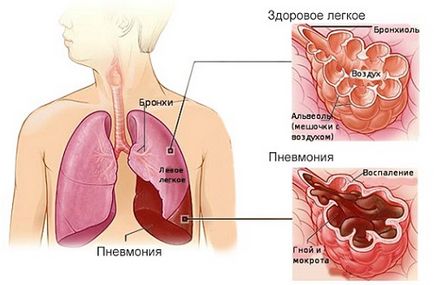 Sirop de lemn dulce de la tuse proprietăți utile și metode de aplicare