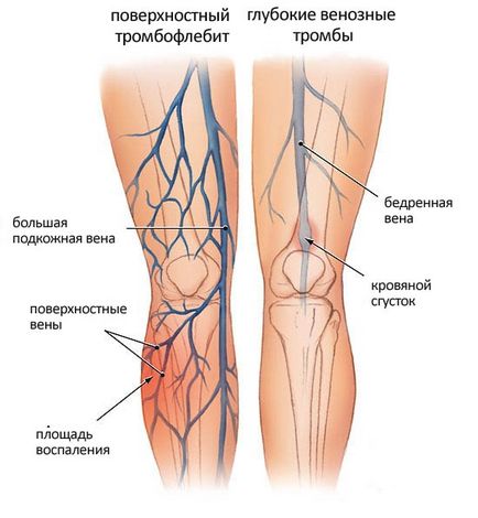 Тромбофлебіт що це, діагностика, методи лікування