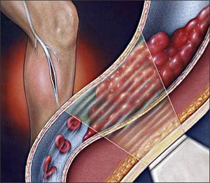 Tromboflebita ce este, diagnosticarea, metodele de tratament