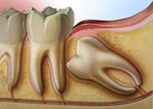 Видалення нерва в зубі