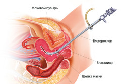 Eliminarea complicațiilor și consecințelor polipului endometrial