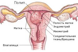 Eliminarea complicațiilor și consecințelor polipului endometrial
