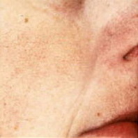 Видалення судин лазером - на обличчі і тілі
