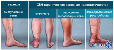 Венотоникі при варикозі ніг, порушення венозного відтоку, геморої, препарати