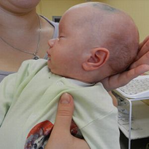Вентрикуліт (Епендіма) у новонароджених лікування, наслідки
