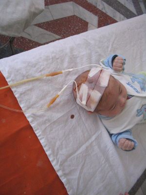 Вентрикуліт (Епендіма) у новонароджених лікування, наслідки