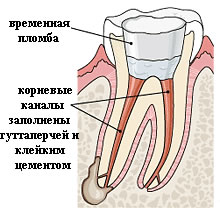 Вертикальна конденсація гутаперчі в стоматології