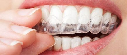 Kiegyenesítése fogak nélkül fogszabályozó felnőtteknek ár