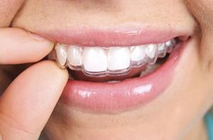Dentiții de înălțare pentru adulți fără prelate