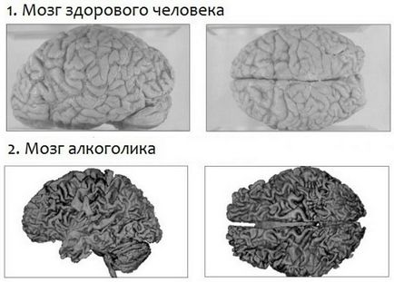 Вплив алкоголю на мозок людини