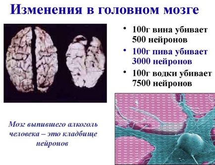 Efectul alcoolului asupra creierului uman