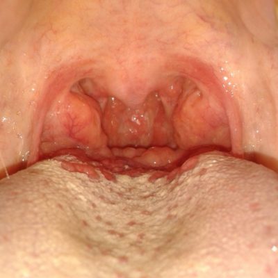 Blisterele de la rădăcina limbii provoacă conuri, posibile boli